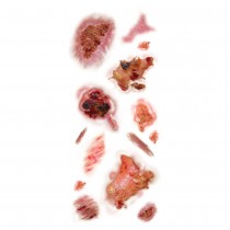 TATOUAGES ÉPHÉMÈRES BLESSURES PLAIES INFECTÉES